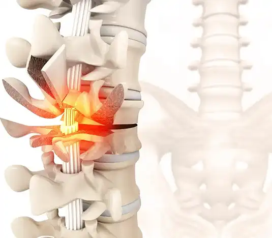 The level and severity of the injury determines losses from the injury